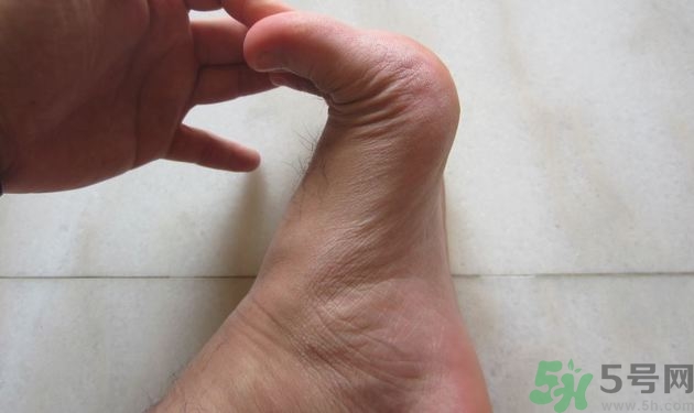 腳拇指外翻遺傳嗎？腳拇指外翻怎么矯正？