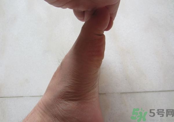 腳拇指外翻遺傳嗎？腳拇指外翻怎么矯正？