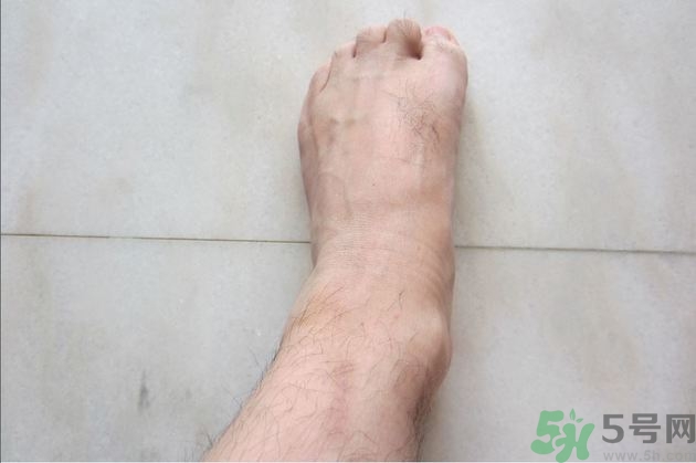 腳拇指外翻遺傳嗎？腳拇指外翻怎么矯正？