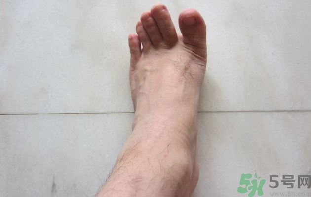 腳拇指外翻遺傳嗎？腳拇指外翻怎么矯正？