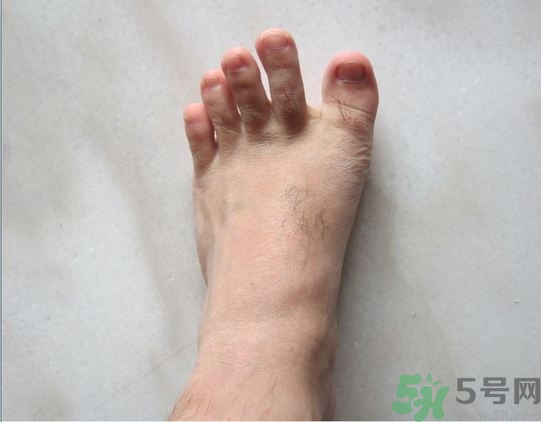 腳拇指外翻遺傳嗎？腳拇指外翻怎么矯正？