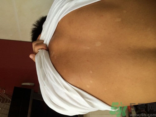 汗斑怎么治才能根除?汗斑用什么藥擦最有效 汗斑怎么治才能根除?汗斑用什么藥擦最有效