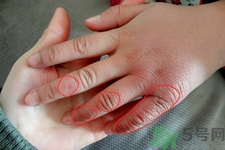 患凍瘡用溫水泡最好嗎？患凍瘡用熱水泡還是冷水泡好？