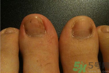 腳趾甲變黑是什么原因？腳趾甲變黑是怎么回事？