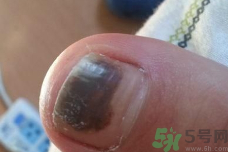 腳趾甲變黑是什么原因？腳趾甲變黑是怎么回事？