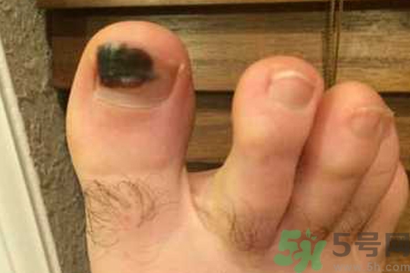 腳趾甲變黑是什么原因？腳趾甲變黑是怎么回事？