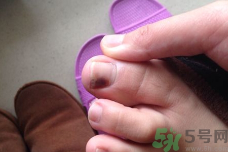 腳趾甲變黑是什么原因？腳趾甲變黑是怎么回事？