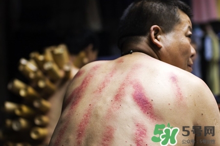 刮痧后什么顏色才健康？刮痧顏色反映的病癥