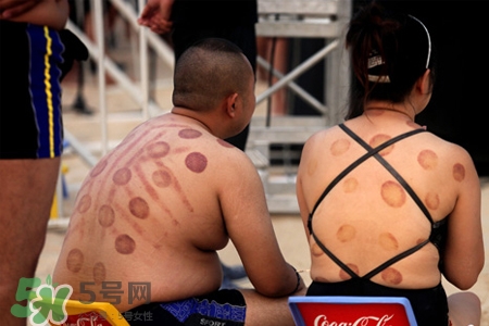 拔罐后可以泡澡嗎？拔罐后多久能泡澡？