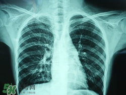 肺炎會傳染嗎?肺炎吃什么好得快 肺炎會傳染嗎?肺炎吃什么好得快