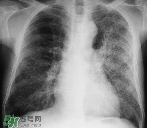 肺炎會傳染嗎?肺炎吃什么好得快 肺炎會傳染嗎?肺炎吃什么好得快