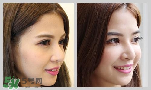 蘋(píng)果肌下垂怎么提拉上去?蘋(píng)果肌下垂怎么辦? 蘋(píng)果肌下垂怎么提拉上去?蘋(píng)果肌下垂怎么辦?