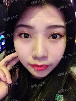 切開雙眼皮消腫過程圖_切開雙眼皮恢復(fù)過程圖 切開雙眼皮消腫過程圖_切開雙眼皮恢復(fù)過程圖