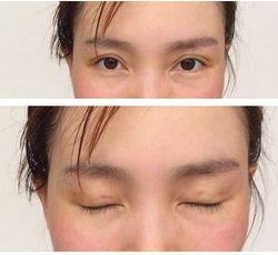 三點雙眼皮恢復過程圖_韓式三點雙眼皮多久恢復自然 三點雙眼皮恢復過程圖_韓式三點雙眼皮多久恢復自然