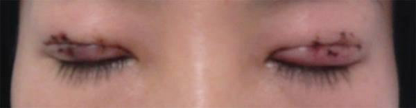 三點(diǎn)雙眼皮恢復(fù)過程圖_韓式三點(diǎn)雙眼皮多久恢復(fù)自然 三點(diǎn)雙眼皮恢復(fù)過程圖_韓式三點(diǎn)雙眼皮多久恢復(fù)自然