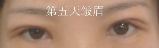 三點(diǎn)雙眼皮恢復(fù)過程圖_韓式三點(diǎn)雙眼皮多久恢復(fù)自然 三點(diǎn)雙眼皮恢復(fù)過程圖_韓式三點(diǎn)雙眼皮多久恢復(fù)自然