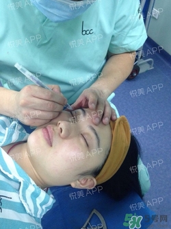 切開雙眼皮消腫過程圖_切開雙眼皮恢復(fù)過程圖 切開雙眼皮消腫過程圖_切開雙眼皮恢復(fù)過程圖