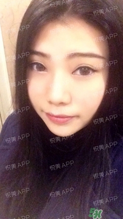 切開雙眼皮消腫過程圖_切開雙眼皮恢復(fù)過程圖 切開雙眼皮消腫過程圖_切開雙眼皮恢復(fù)過程圖