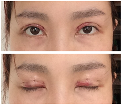 三點雙眼皮恢復過程圖_韓式三點雙眼皮多久恢復自然 三點雙眼皮恢復過程圖_韓式三點雙眼皮多久恢復自然