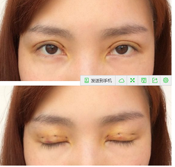 三點雙眼皮恢復過程圖_韓式三點雙眼皮多久恢復自然 三點雙眼皮恢復過程圖_韓式三點雙眼皮多久恢復自然