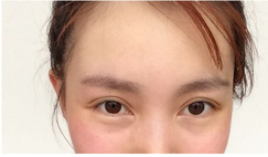 三點雙眼皮恢復過程圖_韓式三點雙眼皮多久恢復自然 三點雙眼皮恢復過程圖_韓式三點雙眼皮多久恢復自然