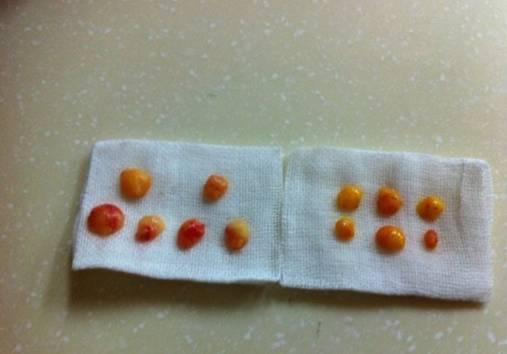 韓式三點雙眼皮是永久嗎？三點雙眼皮能保持多久？