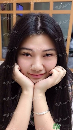 切開雙眼皮消腫過程圖_切開雙眼皮恢復(fù)過程圖 切開雙眼皮消腫過程圖_切開雙眼皮恢復(fù)過程圖