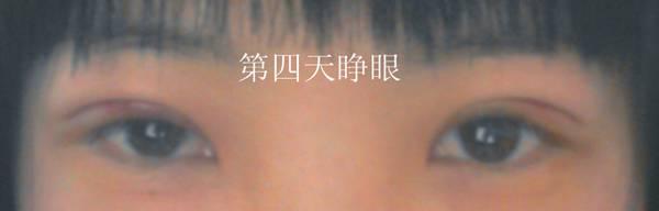 三點(diǎn)雙眼皮恢復(fù)過程圖_韓式三點(diǎn)雙眼皮多久恢復(fù)自然 三點(diǎn)雙眼皮恢復(fù)過程圖_韓式三點(diǎn)雙眼皮多久恢復(fù)自然
