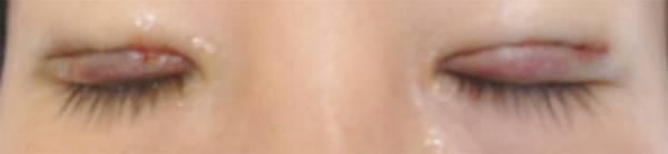 三點(diǎn)雙眼皮恢復(fù)過程圖_韓式三點(diǎn)雙眼皮多久恢復(fù)自然 三點(diǎn)雙眼皮恢復(fù)過程圖_韓式三點(diǎn)雙眼皮多久恢復(fù)自然