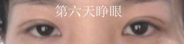 三點(diǎn)雙眼皮恢復(fù)過程圖_韓式三點(diǎn)雙眼皮多久恢復(fù)自然 三點(diǎn)雙眼皮恢復(fù)過程圖_韓式三點(diǎn)雙眼皮多久恢復(fù)自然