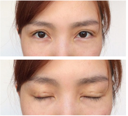 三點雙眼皮恢復過程圖_韓式三點雙眼皮多久恢復自然 三點雙眼皮恢復過程圖_韓式三點雙眼皮多久恢復自然