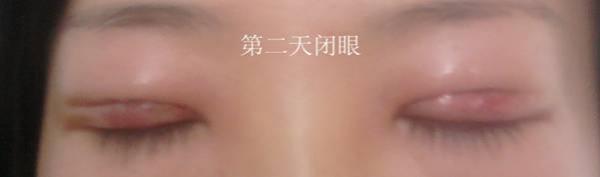 三點(diǎn)雙眼皮恢復(fù)過程圖_韓式三點(diǎn)雙眼皮多久恢復(fù)自然 三點(diǎn)雙眼皮恢復(fù)過程圖_韓式三點(diǎn)雙眼皮多久恢復(fù)自然