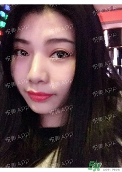 切開雙眼皮消腫過程圖_切開雙眼皮恢復(fù)過程圖 切開雙眼皮消腫過程圖_切開雙眼皮恢復(fù)過程圖