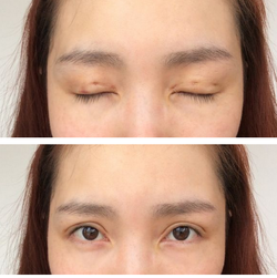 三點雙眼皮恢復過程圖_韓式三點雙眼皮多久恢復自然 三點雙眼皮恢復過程圖_韓式三點雙眼皮多久恢復自然