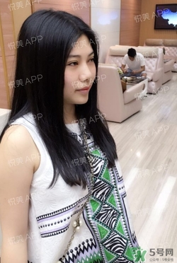 切開雙眼皮消腫過程圖_切開雙眼皮恢復(fù)過程圖 切開雙眼皮消腫過程圖_切開雙眼皮恢復(fù)過程圖