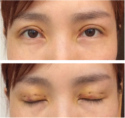 三點雙眼皮恢復過程圖_韓式三點雙眼皮多久恢復自然 三點雙眼皮恢復過程圖_韓式三點雙眼皮多久恢復自然