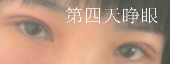 三點(diǎn)雙眼皮恢復(fù)過程圖_韓式三點(diǎn)雙眼皮多久恢復(fù)自然 三點(diǎn)雙眼皮恢復(fù)過程圖_韓式三點(diǎn)雙眼皮多久恢復(fù)自然
