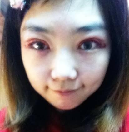 韓式三點雙眼皮是永久嗎？三點雙眼皮能保持多久？