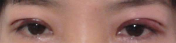 三點(diǎn)雙眼皮恢復(fù)過程圖_韓式三點(diǎn)雙眼皮多久恢復(fù)自然 三點(diǎn)雙眼皮恢復(fù)過程圖_韓式三點(diǎn)雙眼皮多久恢復(fù)自然