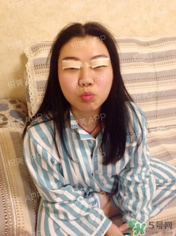 切開雙眼皮消腫過程圖_切開雙眼皮恢復(fù)過程圖 切開雙眼皮消腫過程圖_切開雙眼皮恢復(fù)過程圖