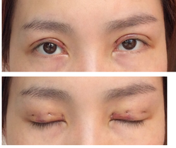 三點雙眼皮恢復過程圖_韓式三點雙眼皮多久恢復自然 三點雙眼皮恢復過程圖_韓式三點雙眼皮多久恢復自然