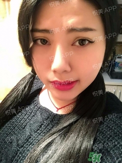 切開雙眼皮消腫過程圖_切開雙眼皮恢復(fù)過程圖 切開雙眼皮消腫過程圖_切開雙眼皮恢復(fù)過程圖