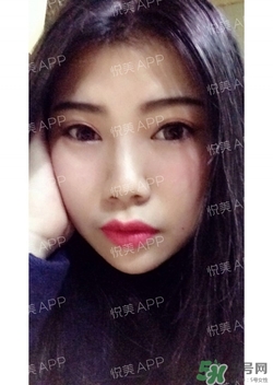 切開雙眼皮消腫過程圖_切開雙眼皮恢復(fù)過程圖 切開雙眼皮消腫過程圖_切開雙眼皮恢復(fù)過程圖