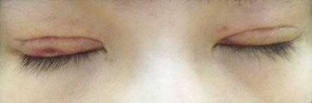 韓式三點雙眼皮是永久嗎？三點雙眼皮能保持多久？