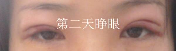 三點(diǎn)雙眼皮恢復(fù)過程圖_韓式三點(diǎn)雙眼皮多久恢復(fù)自然 三點(diǎn)雙眼皮恢復(fù)過程圖_韓式三點(diǎn)雙眼皮多久恢復(fù)自然