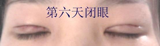 三點(diǎn)雙眼皮恢復(fù)過程圖_韓式三點(diǎn)雙眼皮多久恢復(fù)自然 三點(diǎn)雙眼皮恢復(fù)過程圖_韓式三點(diǎn)雙眼皮多久恢復(fù)自然