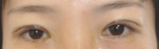 三點(diǎn)雙眼皮恢復(fù)過程圖_韓式三點(diǎn)雙眼皮多久恢復(fù)自然 三點(diǎn)雙眼皮恢復(fù)過程圖_韓式三點(diǎn)雙眼皮多久恢復(fù)自然