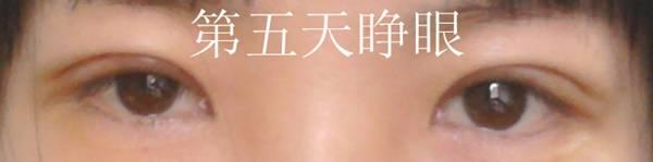 三點(diǎn)雙眼皮恢復(fù)過程圖_韓式三點(diǎn)雙眼皮多久恢復(fù)自然 三點(diǎn)雙眼皮恢復(fù)過程圖_韓式三點(diǎn)雙眼皮多久恢復(fù)自然