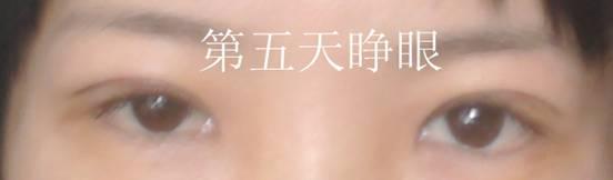 三點(diǎn)雙眼皮恢復(fù)過程圖_韓式三點(diǎn)雙眼皮多久恢復(fù)自然 三點(diǎn)雙眼皮恢復(fù)過程圖_韓式三點(diǎn)雙眼皮多久恢復(fù)自然