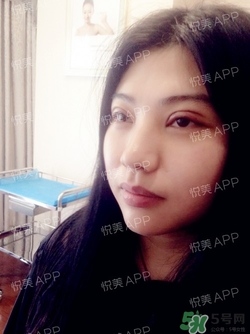 切開雙眼皮消腫過程圖_切開雙眼皮恢復(fù)過程圖 切開雙眼皮消腫過程圖_切開雙眼皮恢復(fù)過程圖